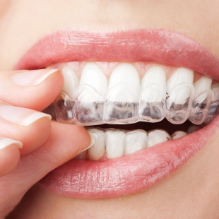 Giảm Đến 10 Triệu Chỉnh Nha Trong Suốt