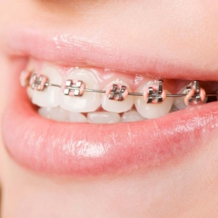 Giảm Đến 5 Triệu Đồng Chỉnh Nha Mắc Cài